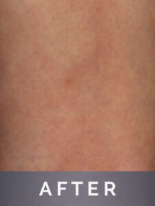 Reticular Veins 26 weeks After Treatment